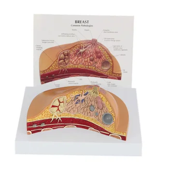 Medicīnas Slimību, Vēža, Krūts Anatomija Modeli Cilvēka Ķermeņa Modeli Anatomisko Patoloģiju Krūts Modelis